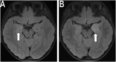 A case report of anti-GAD65 antibody-positive autoimmune encephalitis in children associated with autoimmune polyendocrine syndrome type-II and literature review